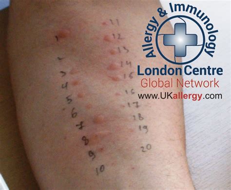 London Allergy Doctors